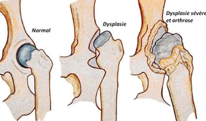 Dysplasie